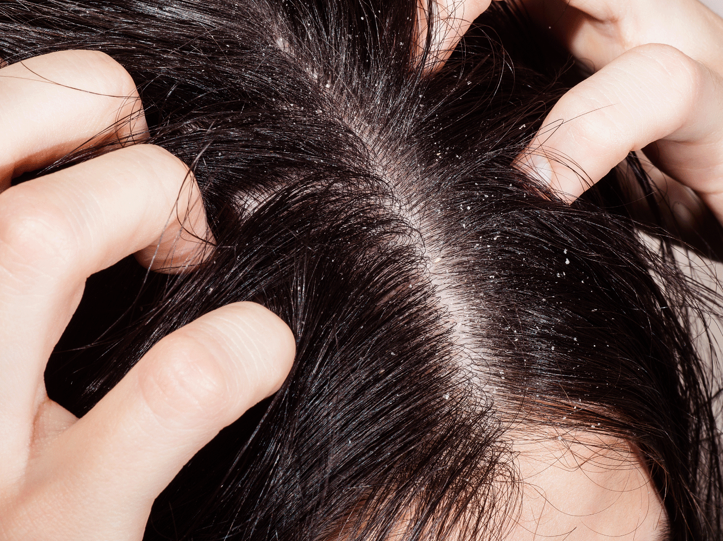 dermatitis seborreica cuero cabelludo