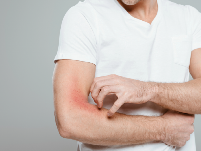 Urticaria