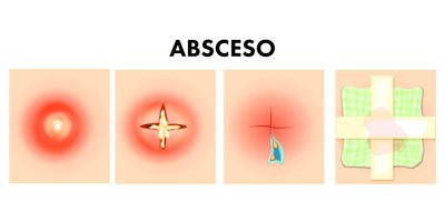 absceso-mobile.jpg