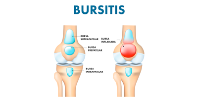 bursitis-mobile.png