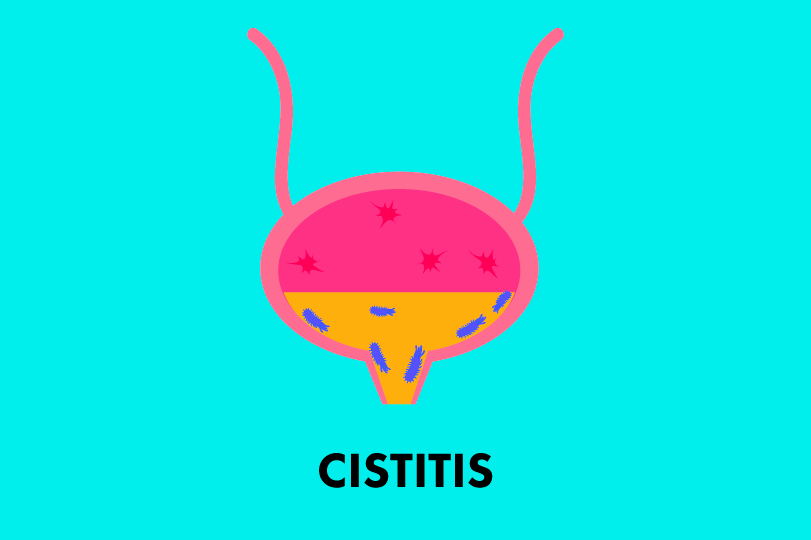 cistitis-op