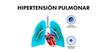 hipertension-pulmonar-mobile.png