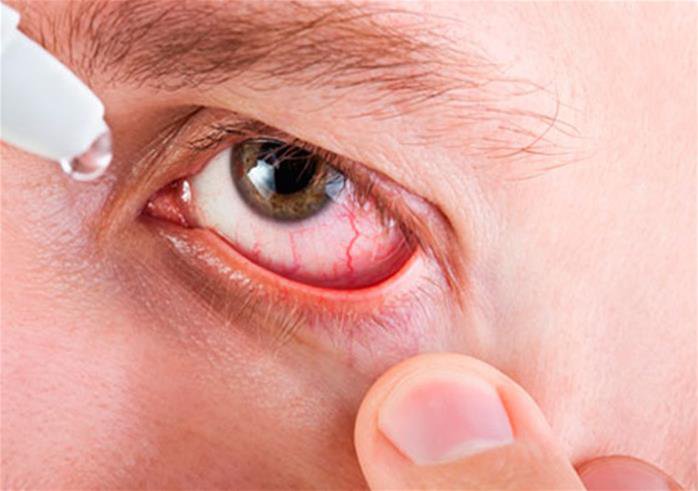 las-alergias-oculares