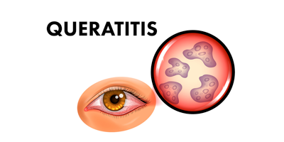 queratitis-mobile.png