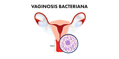 vaginosis-bacteriana-mobile.png